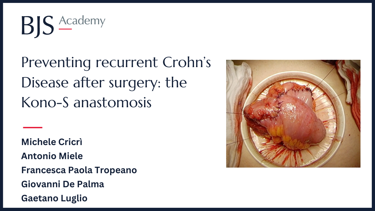 Preventing recurrent Crohn’s Disease after surgery: the Kono-S anastomosis