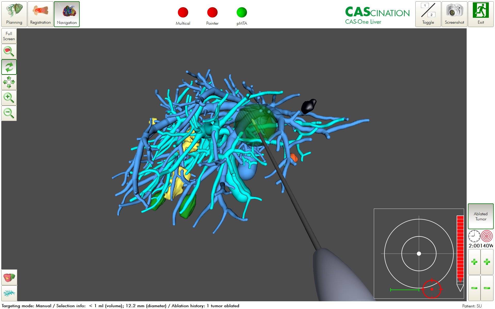 Image-guided ablation for liver tumours – an addition to the armamentarium of multidisciplinary oncological and surgical approaches