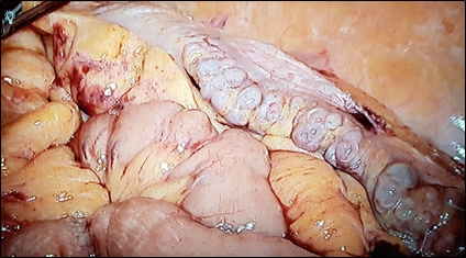 Can recurrent diverticulitis be predicted?