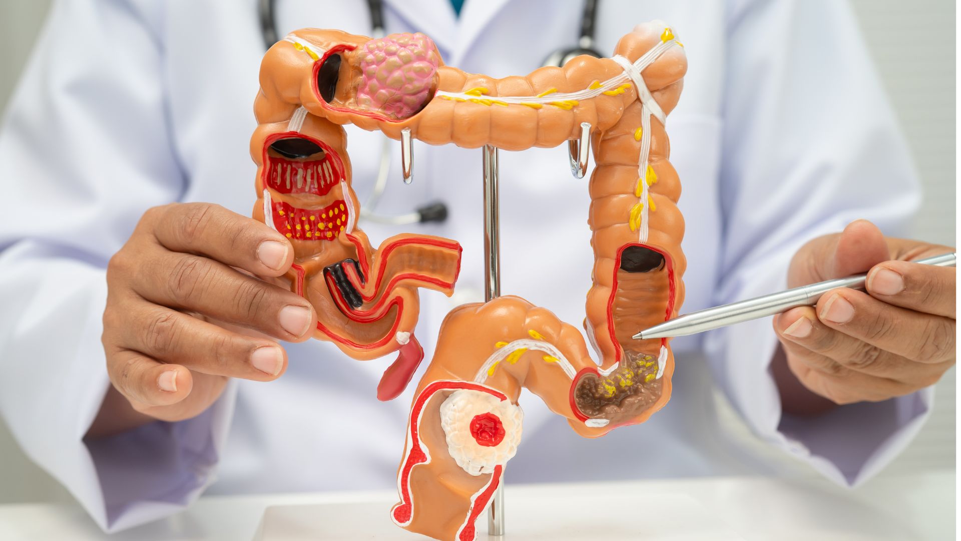 Current therapeutic paradigms for obstructing colon cancer: room for improvement