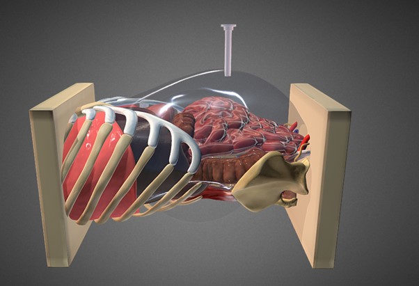 Author’s journey to extraperitoneal left colon surgery.