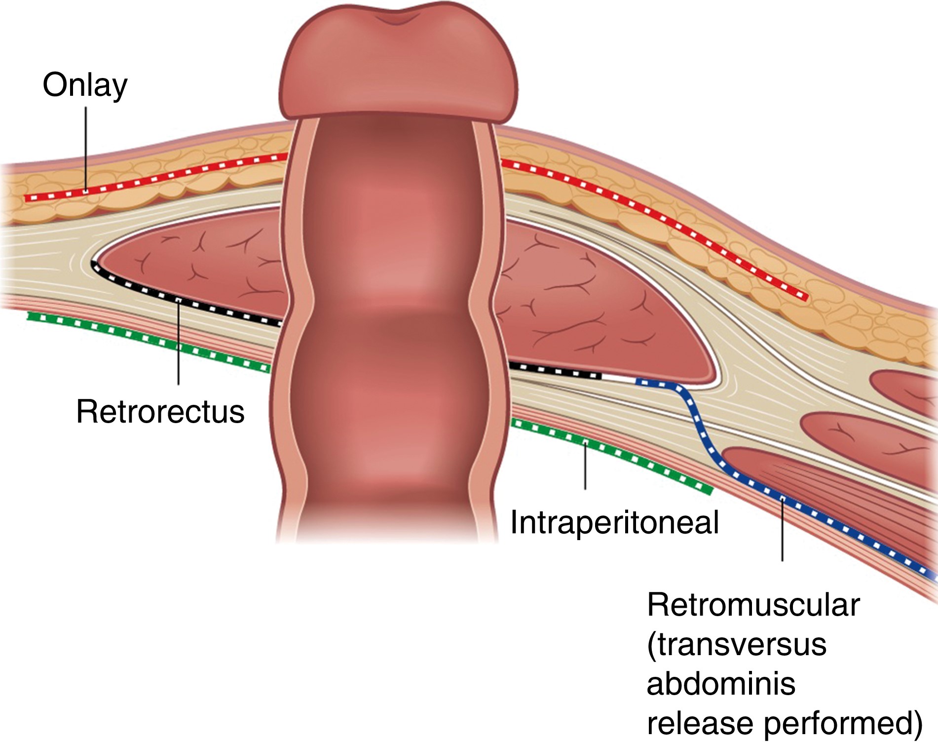 Parastomal hernia: Quality of life