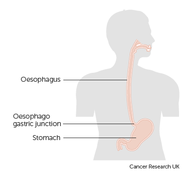 Guest blog: Keyhole versus open surgery for oesophageal cancer